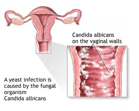 Nấm âm đạo: đối phó thật dễ dàng - Y học - Bệnh lý - Bệnh phụ khoa - Sức khỏe phụ nữ