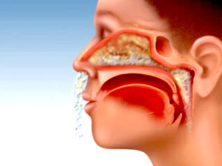 Các dạng viêm mũi thường gặp và cách phòng ngừa