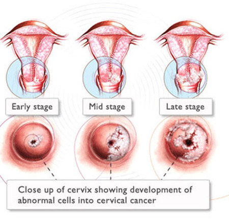 Bệnh ung thư cổ tử cung chủ yếu do hoạt động tình dục - Sức Khỏe - Bệnh ung thư cổ tử cung - Sức khỏe phụ nữ - Sức khỏe tình dục