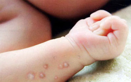 Cha mẹ cần chú ý khi trẻ mắc bệnh thủy đậu Cha mẹ cần chú ý khi trẻ mắc bệnh thủy đậu