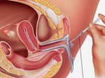 Thụ tinh nhân tạo và những ảnh hưởng tới sức khỏe