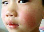 Bệnh quai bị ở trẻ và những điều cần biết