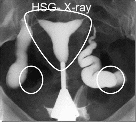 2. Chụp X-quang tử cung – vòi trứng (HSG) 1