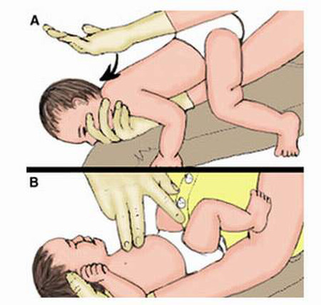 Cách xử lí khi bé bị sặc sữa 2 Cách xử lí khi bé bị sặc sữa 2