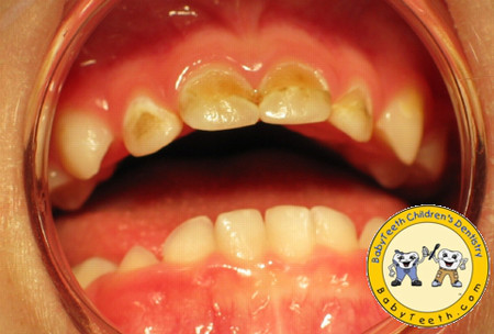 Trẻ bị vàng răng vì nguyên nhân nào, cách phòng tránh ra sao? 1