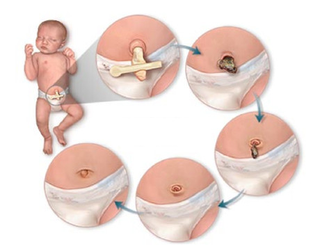 2. Nhiễm khuẩn rốn 1 2. Nhiễm khuẩn rốn 1