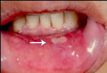 Thuốc điều trị bệnh nhiệt miệng 1 Thuốc điều trị bệnh nhiệt miệng 1
