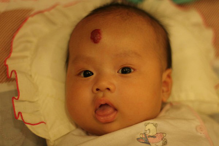 Ngắn chân, khuỳnh tay vì u máu 1 Ngắn chân, khuỳnh tay vì u máu 1