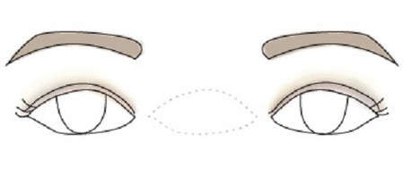 Khoảng cách giữa hai mắt xa nhau 1