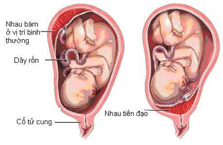 1. Những nguy hại cho mẹ 1