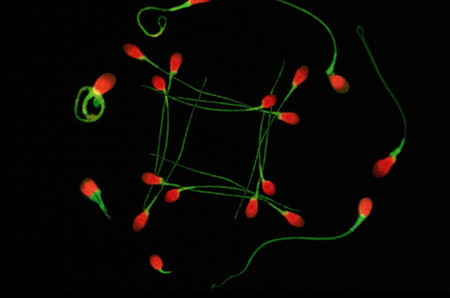 8. Tinh trùng bất thường 1 8. Tinh trùng bất thường 1