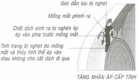 3. Bệnh tăng nhãn áp 1 3. Bệnh tăng nhãn áp 1
