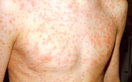 Trị sởi hiệu quả với y học cổ truyền 1 Tổn thương da do sởi.