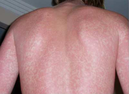 Dấu hiệu của bệnh sốt xuất huyết: 1 Dấu hiệu của bệnh sốt xuất huyết: 1