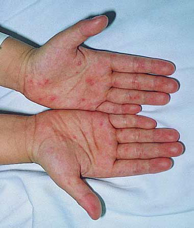 Phương pháp phòng tránh bệnh tay chân miệng 1 Phương pháp phòng tránh bệnh tay chân miệng 1