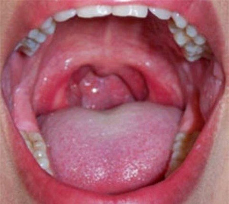 Những dấu hiệu cơ bản để nhận biết bệnh ung thư vòm họng 1