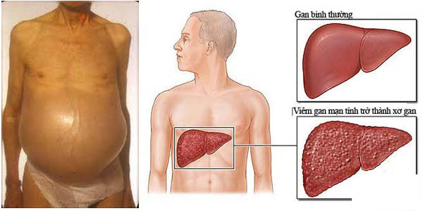 Xơ gan cổ trướng những điều quan trọng nhất 1 Xơ gan cổ trướng những điều quan trọng nhất 1