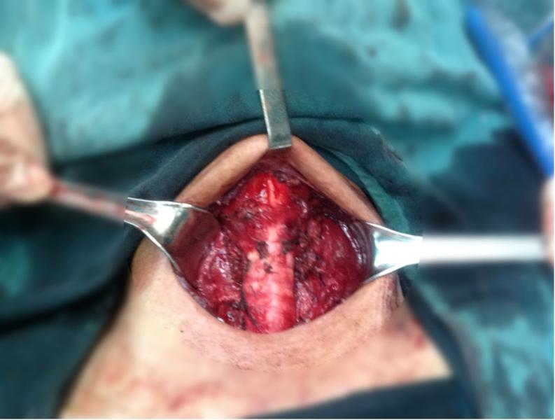 Thế nào là ung thư tuyến giáp di căn hạch cổ 1 Thế nào là ung thư tuyến giáp di căn hạch cổ 1