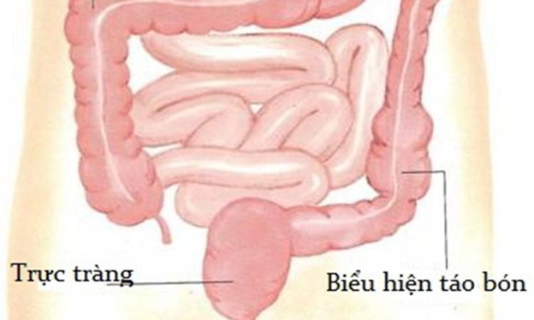 Hội chứng ruột kích thích là gì? 1 Hội chứng ruột kích thích là gì? 1