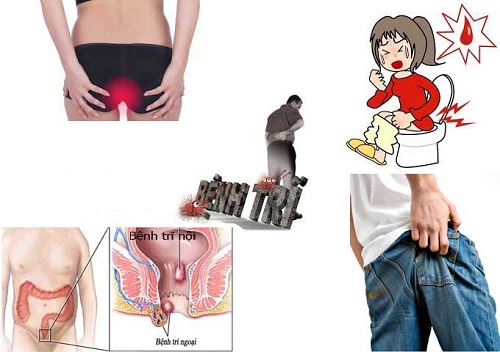 Dấu hiệu của bệnh trĩ 1 Dấu hiệu của bệnh trĩ 1