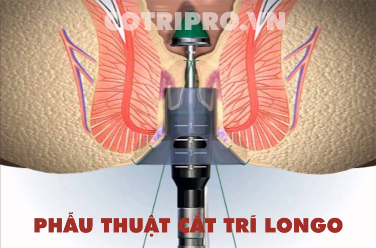 Các phương pháp điều trị bệnh trĩ 1 Các phương pháp điều trị bệnh trĩ 1