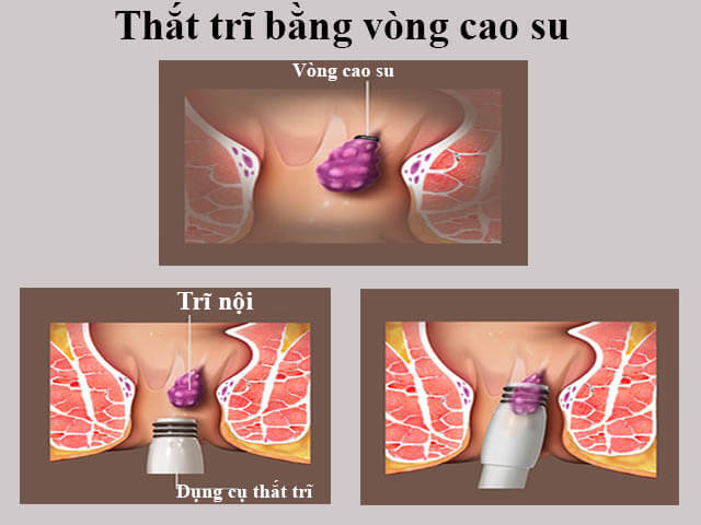 Ưu nhược điểm phương pháp thắt búi trĩ bằng vòng cao su 1 Ưu nhược điểm phương pháp thắt búi trĩ bằng vòng cao su 1