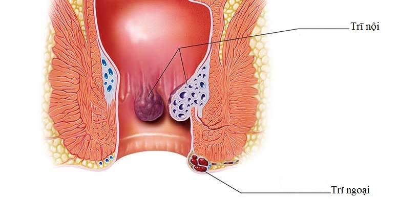 Bệnh trĩ là gì? 1 Bệnh trĩ là gì? 1