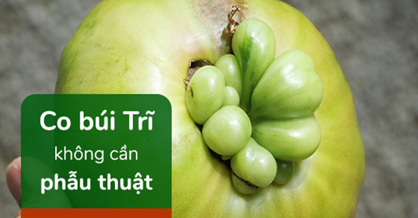 8. Làm sao để Co búi Trĩ không cần phẫu thuật? 1 8. Làm sao để Co búi Trĩ không cần phẫu thuật? 1