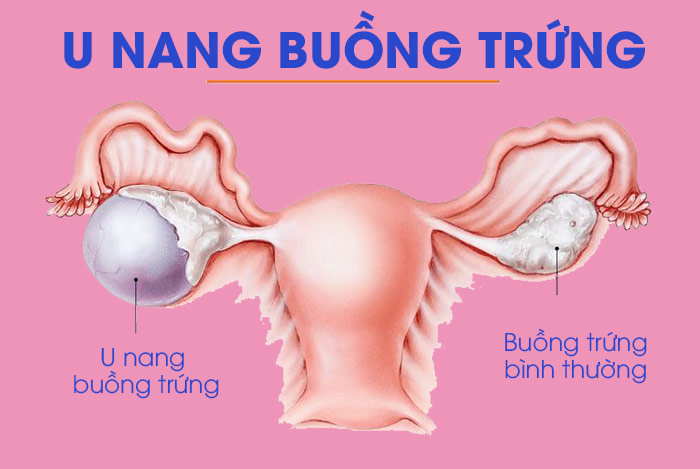 U nang buồng trứng - Phân loại và điều trị 1