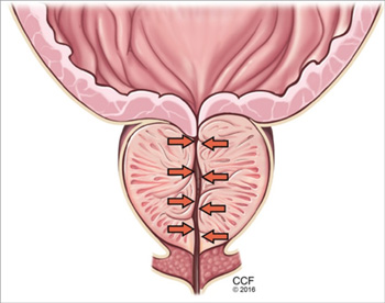 Biến chứng 1 Biến chứng 1