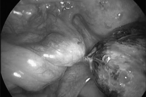 U nang buồng trứng có nguy hiểm không? 1