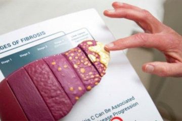 10 điều bạn cần làm nếu bị gan nhiễm mỡ độ 1 10 điều bạn cần làm nếu bị gan nhiễm mỡ độ 1