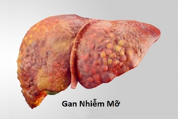 Bệnh gan nhiễm mỡ có nguy hiểm không? 1 Bệnh gan nhiễm mỡ có nguy hiểm không? 1