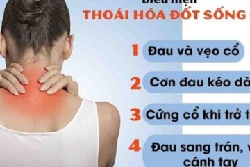 Nguyên nhân và triệu chứng của bệnh thoái hóa đốt sống cổ Nguyên nhân và triệu chứng của bệnh thoái hóa đốt sống cổ