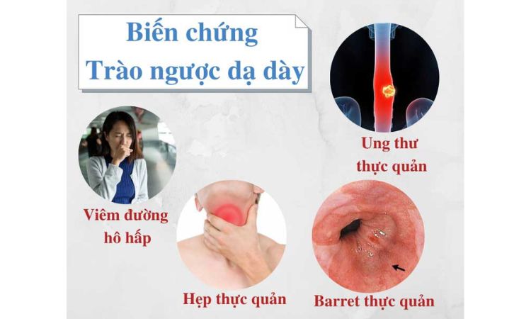 Biến chứng của trào ngược dạ dày thực quản 1 Biến chứng của trào ngược dạ dày thực quản 1