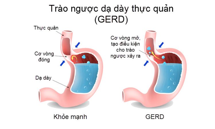 Tại sao lại bị trào ngược dạ dày – thực quản? 1 Tại sao lại bị trào ngược dạ dày – thực quản? 1