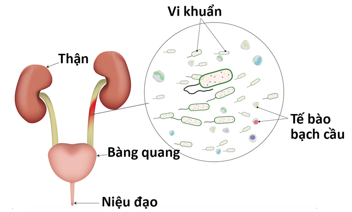 Nhiễm trùng đường tiết niệu 1 Nhiễm trùng đường tiết niệu 1
