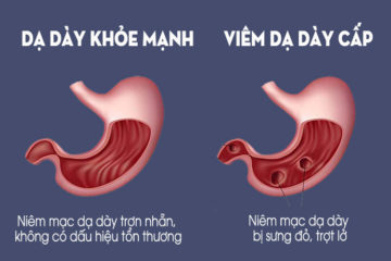Viêm loét dạ dày cấp tính là gì? Có nguy hiểm không? Viêm loét dạ dày cấp tính là gì? Có nguy hiểm không?