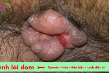 benh-loi-dom-cach-dieu-tri