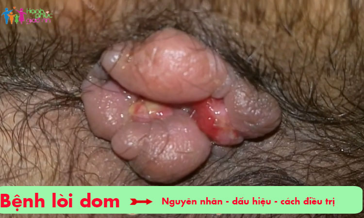 Lòi dom là bệnh gì, nguyên nhân gây bệnh và cách chữa sao cho đúng? 1 Lòi dom là bệnh gì, nguyên nhân gây bệnh và cách chữa sao cho đúng? 1