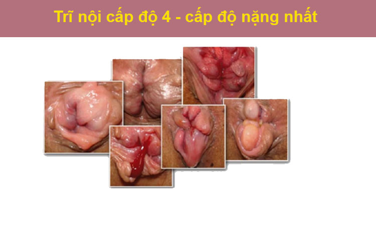 Khi nào nên thực hiện phẫu thuật cắt trĩ nội? 1 Khi nào nên thực hiện phẫu thuật cắt trĩ nội? 1