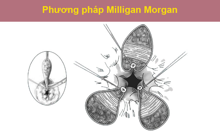 1. Cắt trĩ bằng phương pháp Milligan Morgan 1 1. Cắt trĩ bằng phương pháp Milligan Morgan 1