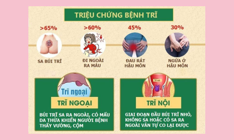 Triệu chứng thường gặp ở bệnh trĩ 1 Triệu chứng thường gặp ở bệnh trĩ 1