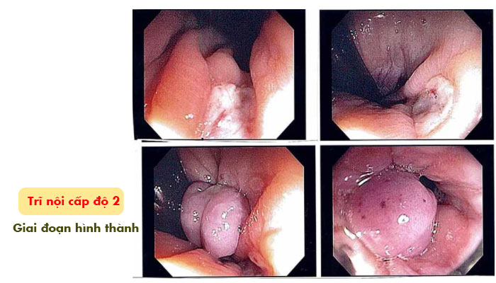 Trĩ cấp độ 2 (hình thành bệnh) có tự khỏi được không? 1 Trĩ cấp độ 2 (hình thành bệnh) có tự khỏi được không? 1