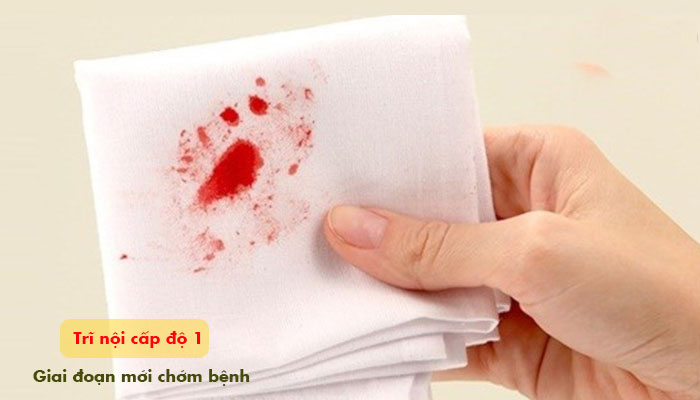 Trĩ cấp độ 1 (mới chớm bệnh) có tự khỏi được không? 1 Trĩ cấp độ 1 (mới chớm bệnh) có tự khỏi được không? 1