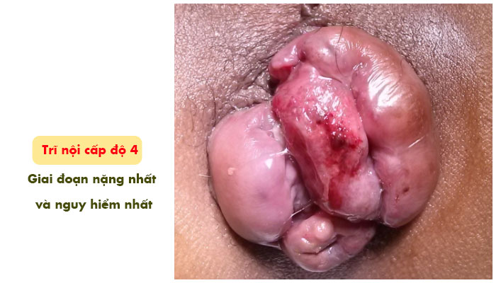 Bệnh trĩ nội giai đoạn nặng: Trĩ nội cấp độ 3, 4 1 Bệnh trĩ nội giai đoạn nặng: Trĩ nội cấp độ 3, 4 1