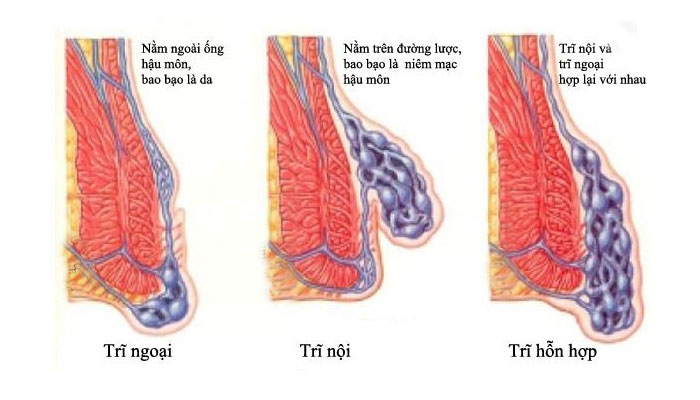 Phân loại trĩ 1 Phân loại trĩ 1