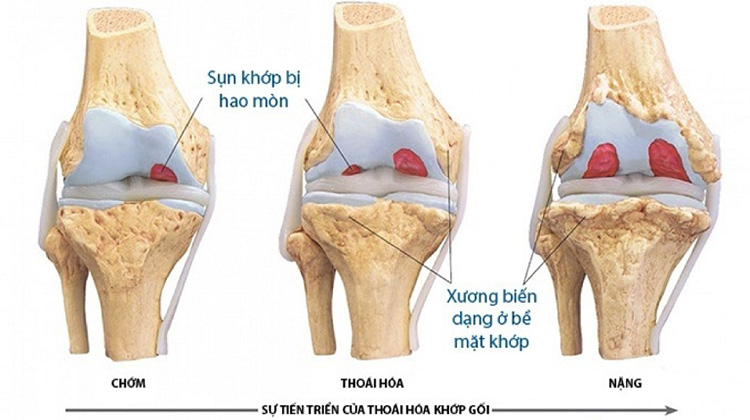 Thoái hóa khớp là gì? 1 Thoái hóa khớp là gì? 1