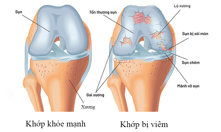 Hiểu nhanh về viêm khớp 1