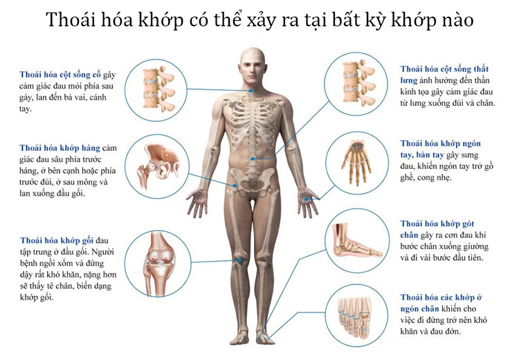Thoái hóa khớp có đáng lo? 1